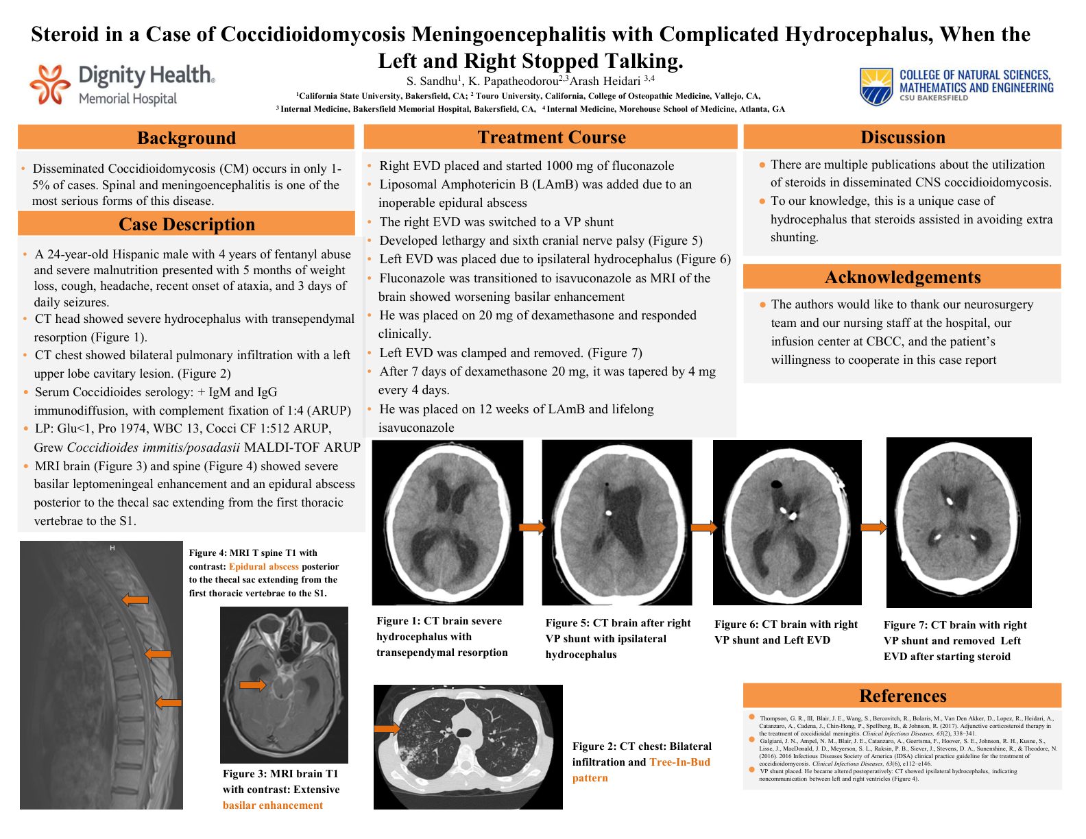 Steroid in Cocci Meningoencephalitis with Hydrocephalus